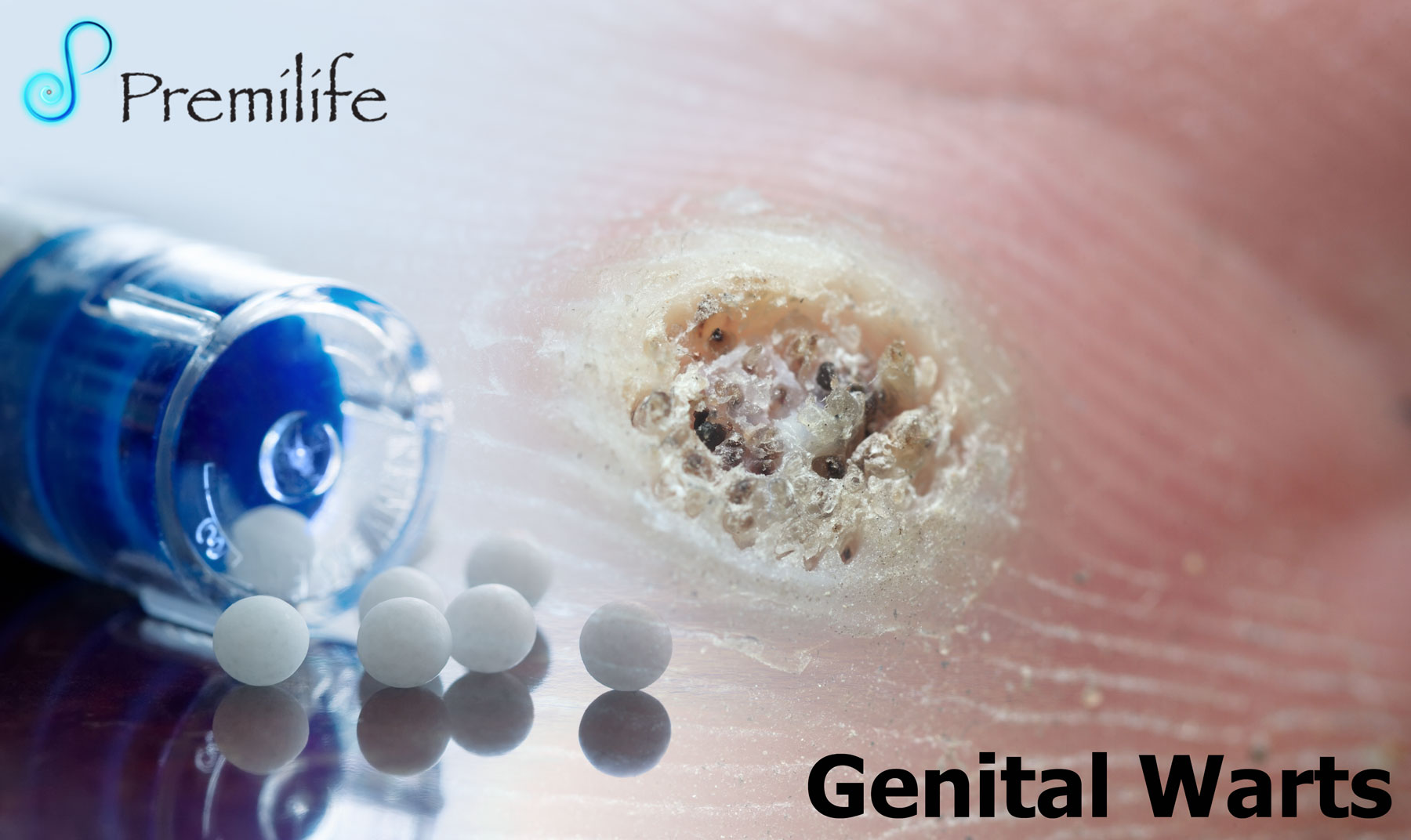 genital warts treatment in homeopathy