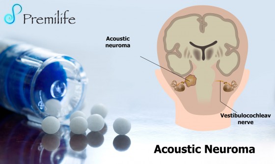 Acoustic-Neuroma