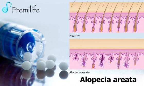 Alopecia-areata