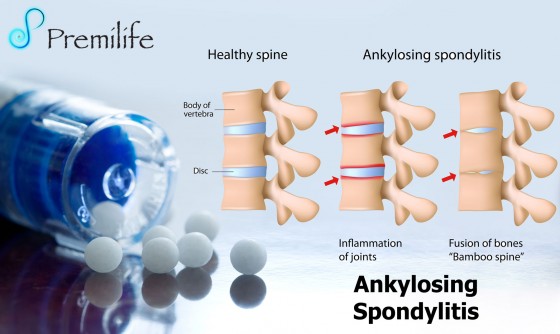 Ankylosing-Spondylitis