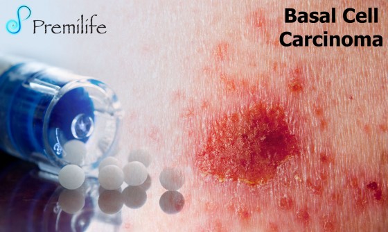 Basal-Cell-Carcinoma