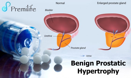 Benign-Prostatic-Hypertrophy Benign-Prostatic-Hypertrophy