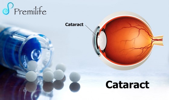 Cataract Cataract