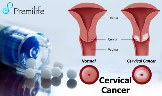 Cervical-Cancer Cervical-Cancer