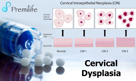 Cervical-Dysplasia