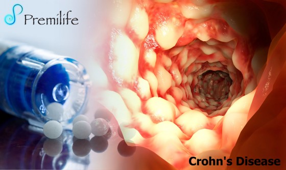 Crohn's-Disease