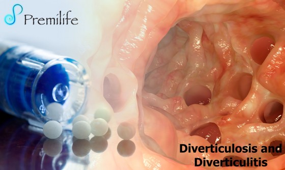 Diverticulosis-and-Diverticulitis