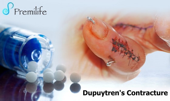 Dupuytren's-Contracture