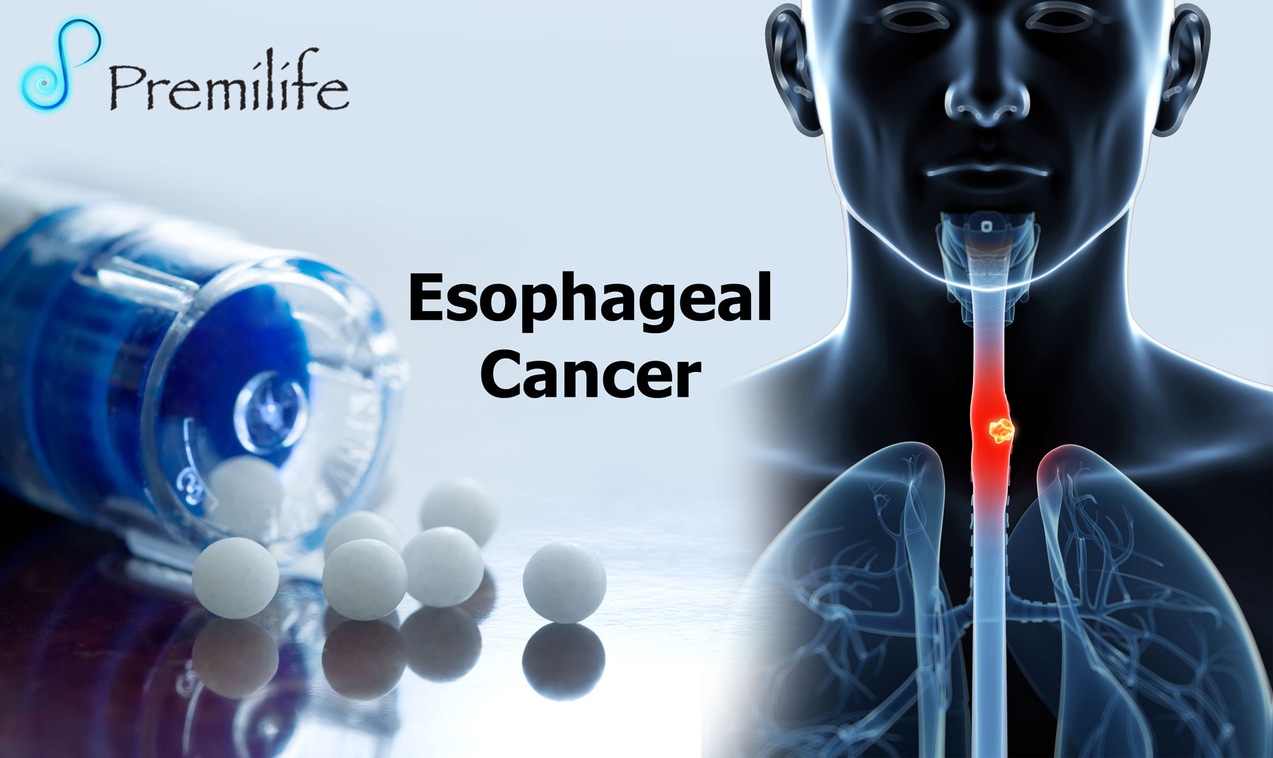 Esophageal Cancer Diagram