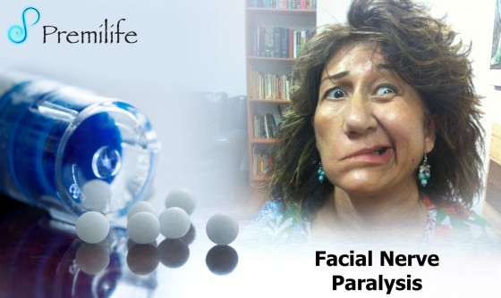 Facial-nerve-paralysis