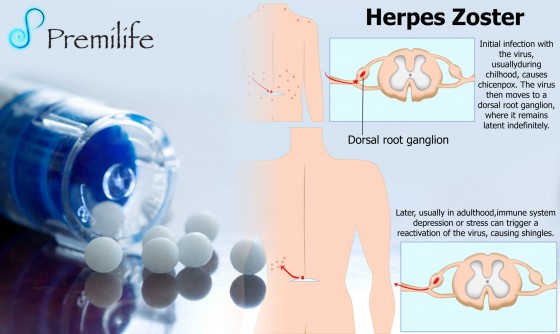 Herpes-Zoster Herpes-Zoster