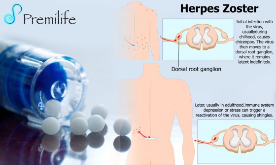 Herpes-Zoster