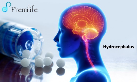 Hydrocephalus Hydrocephalus