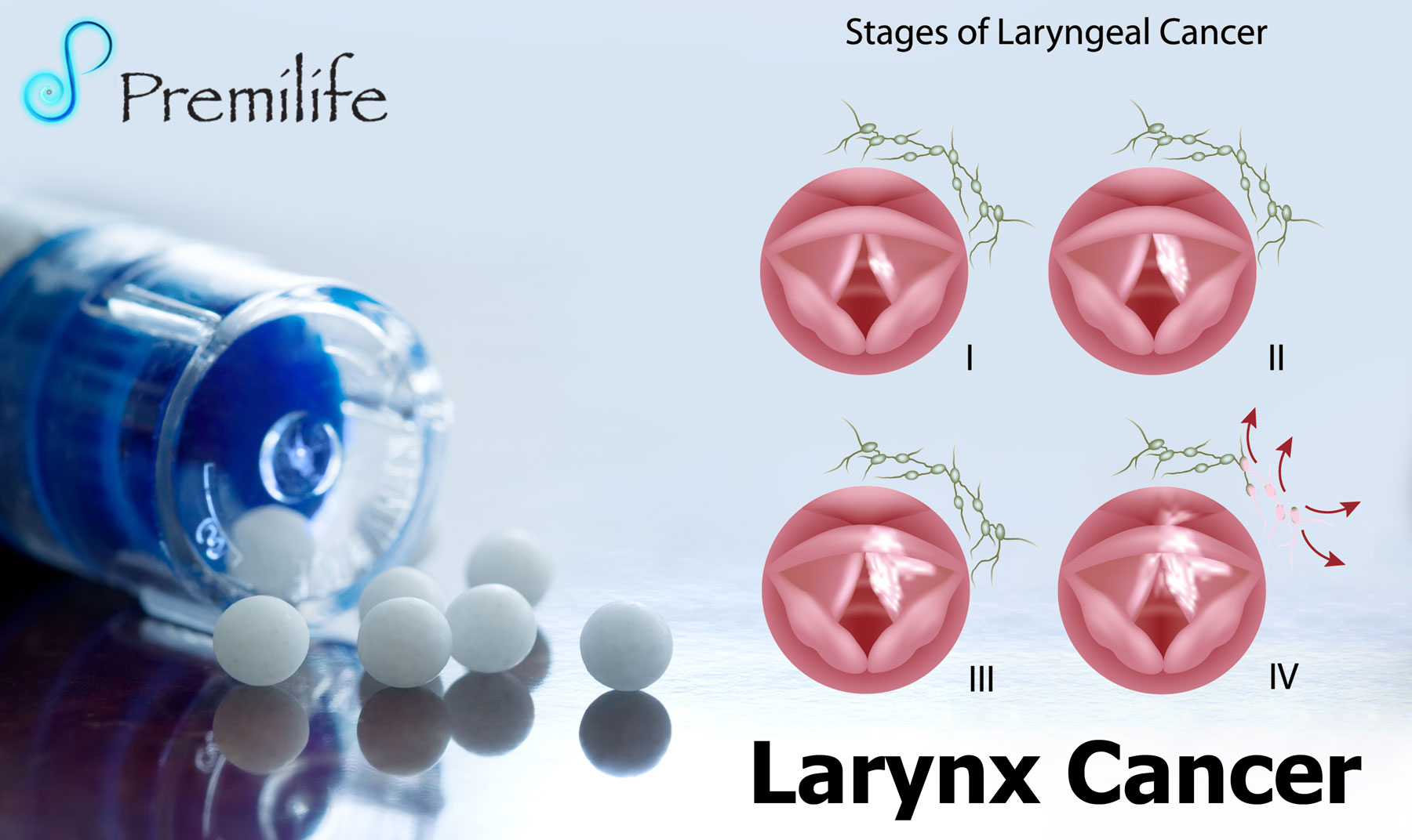 Larynx Cancer - Premilife - Homeopathic Remedies