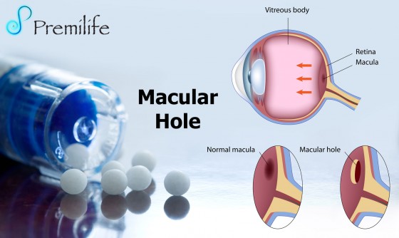Macular-hole