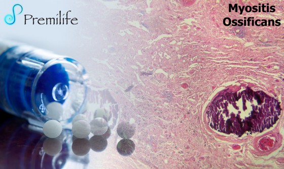 Myositis-ossificans Myositis-ossificans