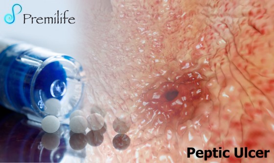 Peptic-Ulcer Peptic-Ulcer