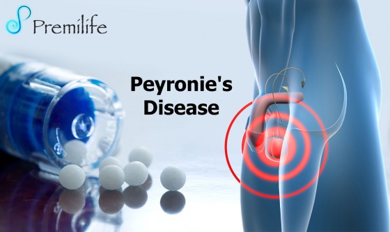 Peyronie's-Disease
