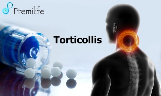Torticollis