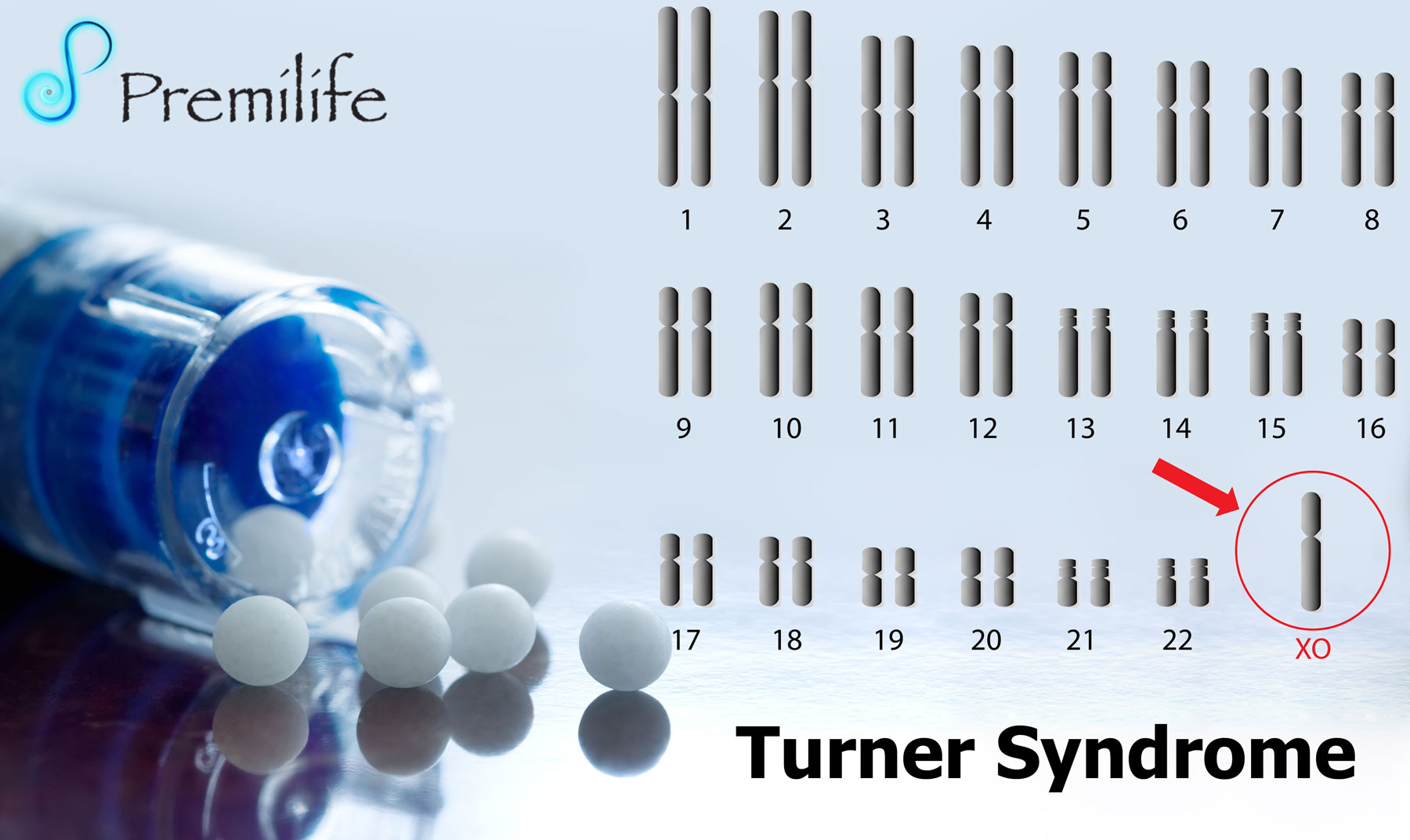 Turner Syndrome.