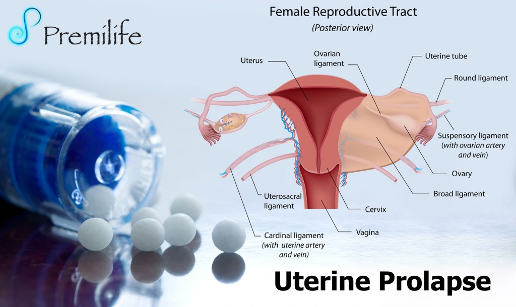 Uterine Prolapse  Premilife - Homeopathic Remedies