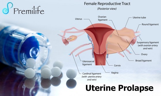Uterine-Prolapse Uterine-Prolapse