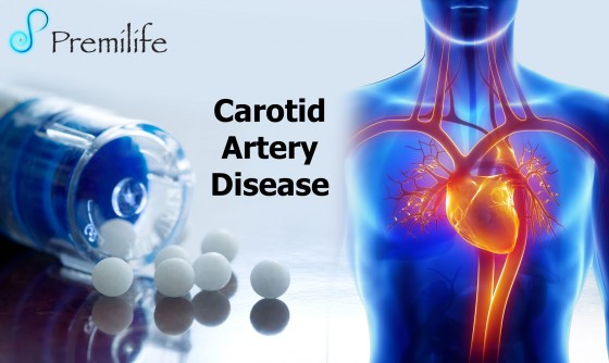 Carotid-Artery-Disease