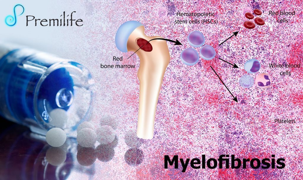 Myelofibrosis Bone Marrow