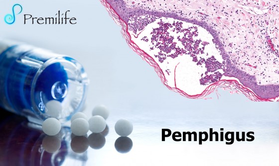 Pemphigus Pemphigus
