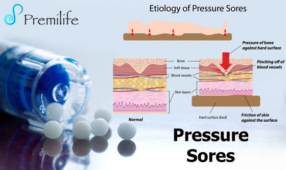 Pressure-Sores