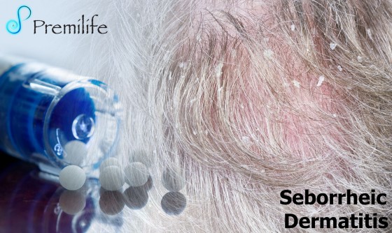 Seborrheic-Dermatitis