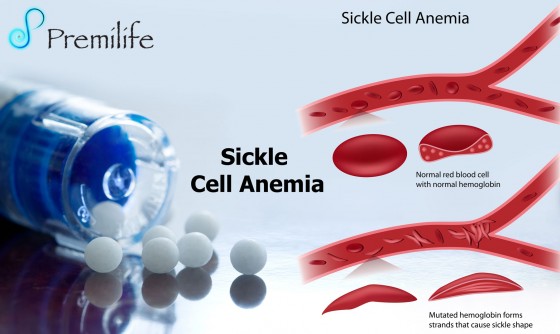 Sickle-Cell-Anemia