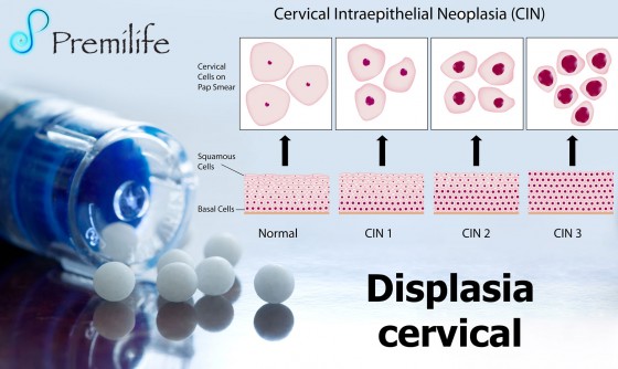 cervical-dysplasia-spanish