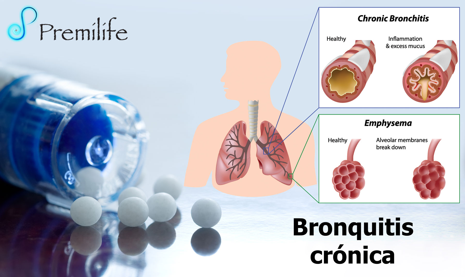 Эмфизема хронического бронхита. Chronic obstructive Pulmonary disease (COPD). Chronic lung disease (хроническая болезнь лёгких). Хронический бронхит макро.