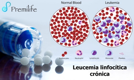 chronic-lymphocytic-leukemia-spanish
