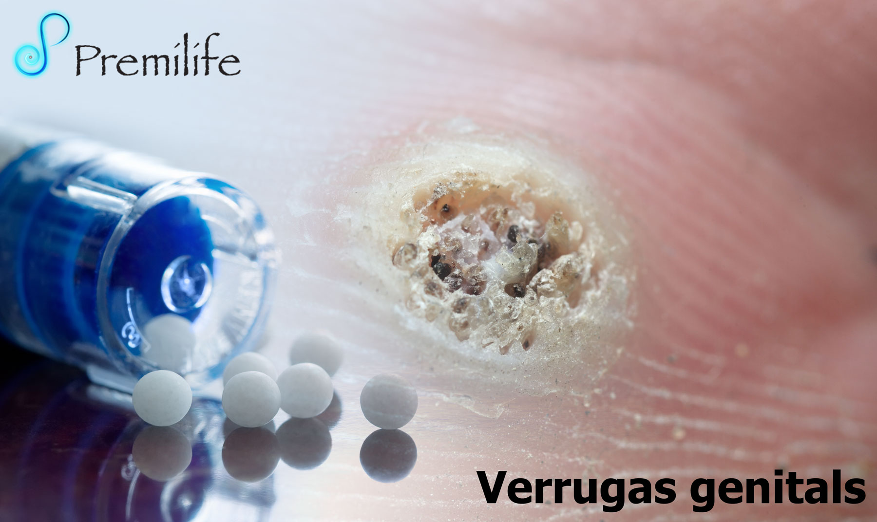 Verrugas genitals | Premilife - Homeopathic Remedies