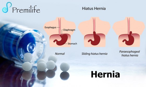 hernia-spanish hernia-spanish
