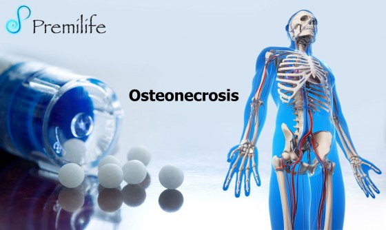 osteonecrosis-spanish