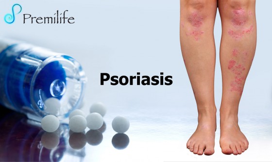 psoriasis-spanish