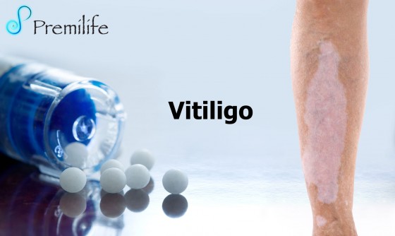 vitiligo-spanish