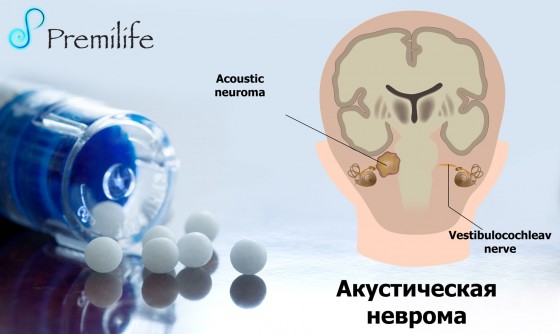 Acoustic-Neuroma-russian