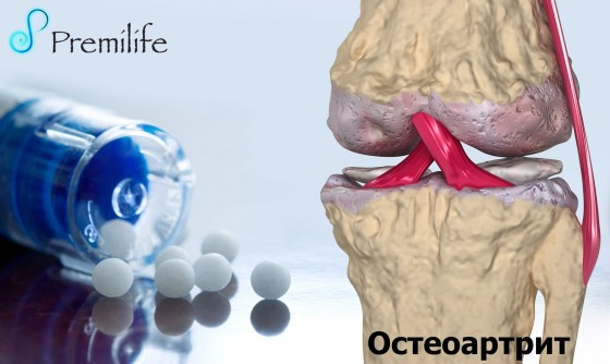 Osteoarthritis-russian