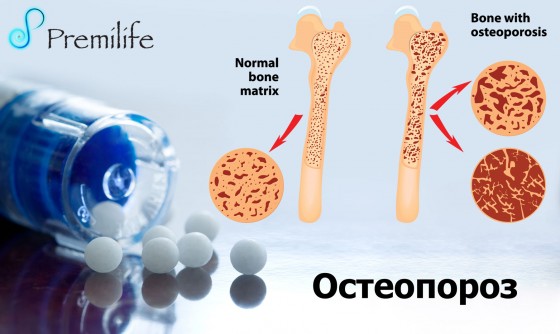 Osteoporosis-russian