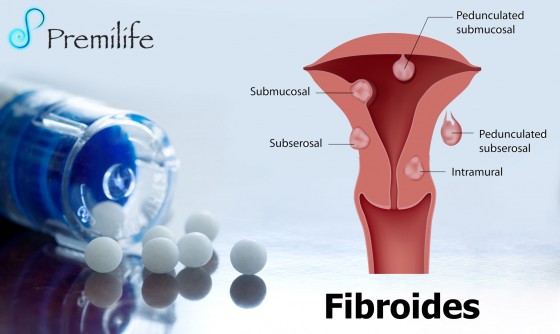 fibroids-spanish