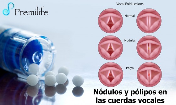 vocal-cord-nodules-and-polyps-spanish