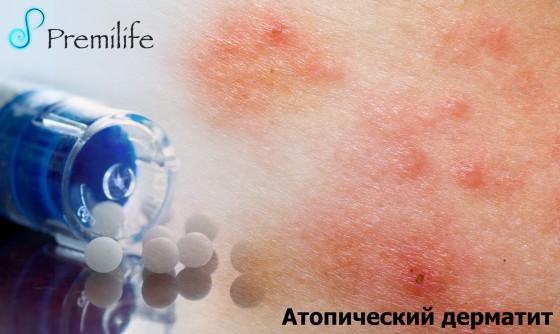 Atopic-Dermatitis-russian