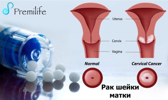 Cervical-Cancer-russian Cervical-Cancer-russian