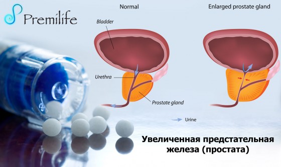 Enlarged-prostate-russian Enlarged-prostate-russian