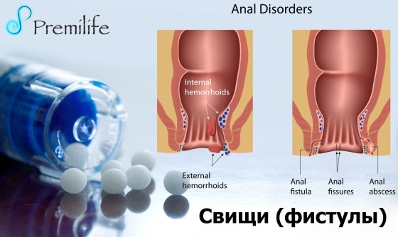Fistulas-russian Fistulas-russian