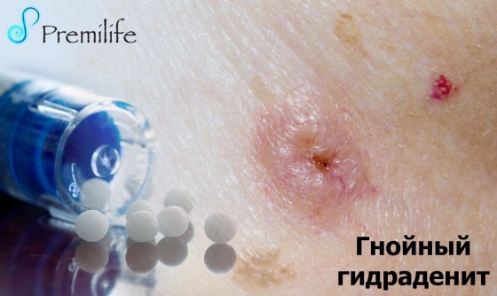 Hidradenitis-Suppurativa-russian Hidradenitis-Suppurativa-russian
